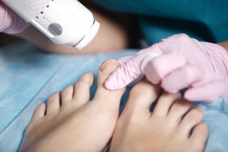 24549386 S laser surgery foot woman doctor toe nail fungus podiatrist patient