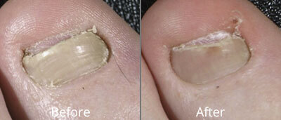 laser nail fungus treatment clear toe ClearToe before after syracuse new york ny cny cosmetic reconstuctive surgery thumb 1