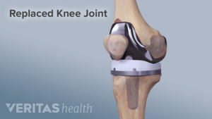 replaced knee joint illustration